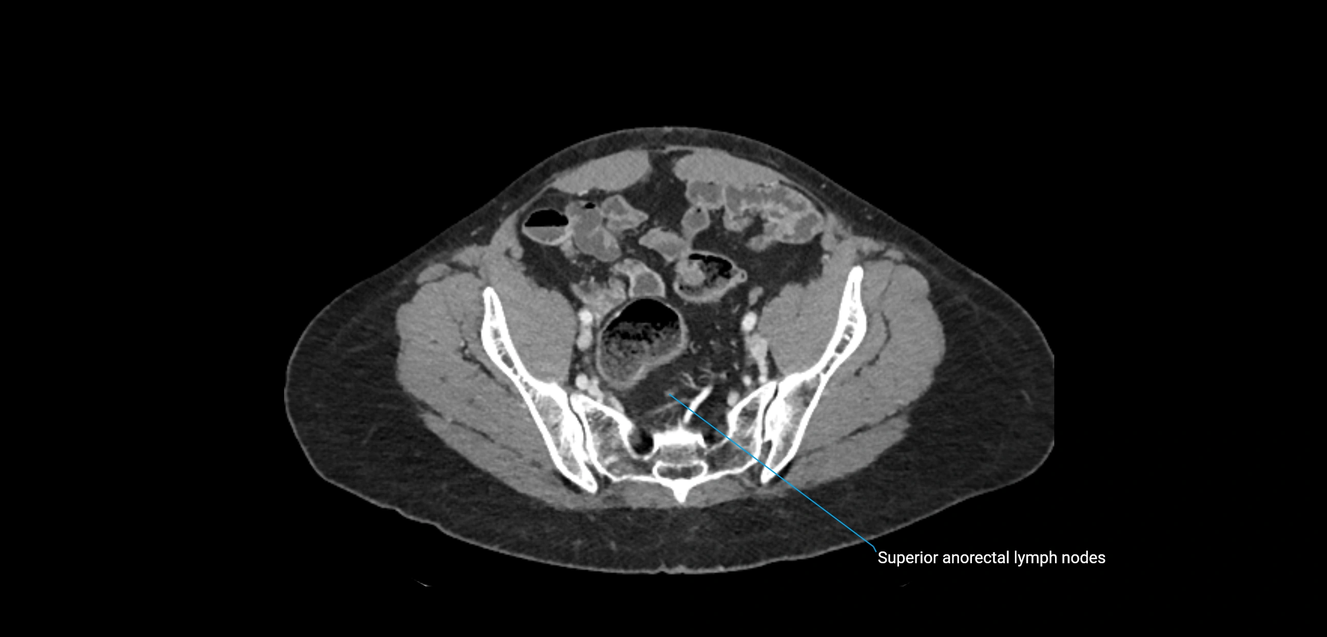 CT ct abdominal lymph nodes  axial cross sectional anatomy  enchanced radiology image -img-00002-00337.webp